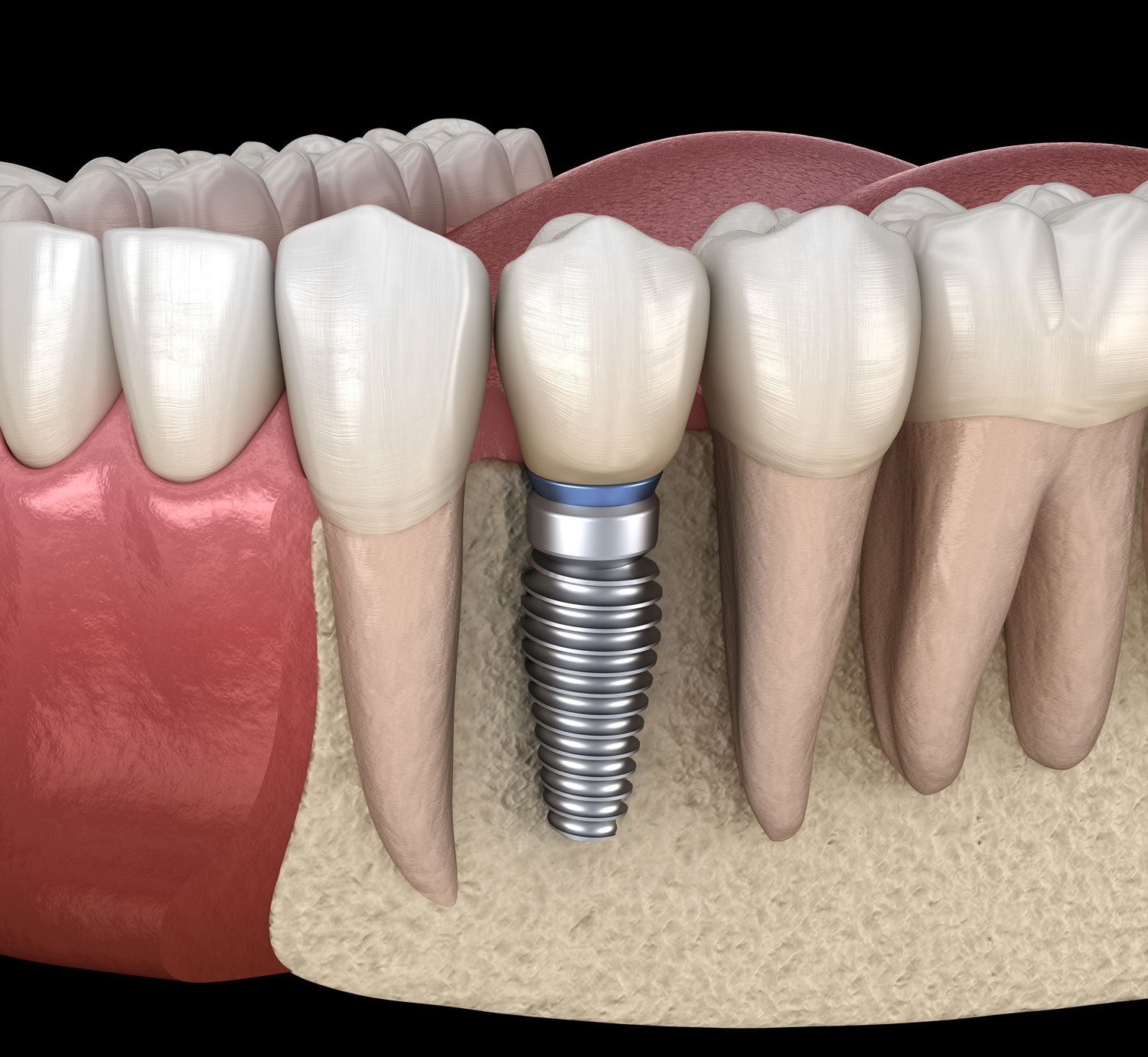 インプラント治療の奥歯