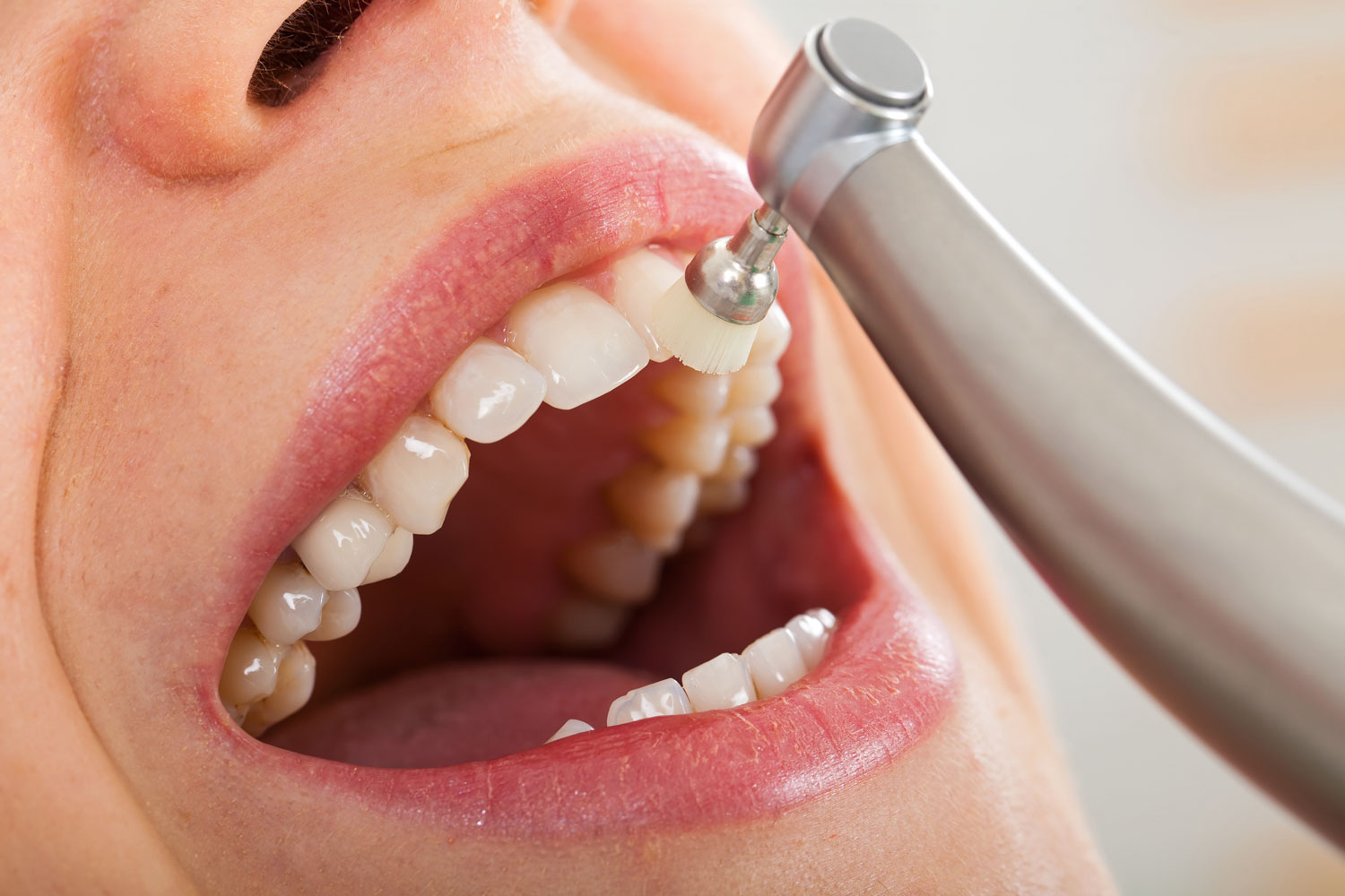 歯周病の治療例の画像