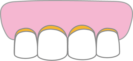 すきっ歯Dのイメージ