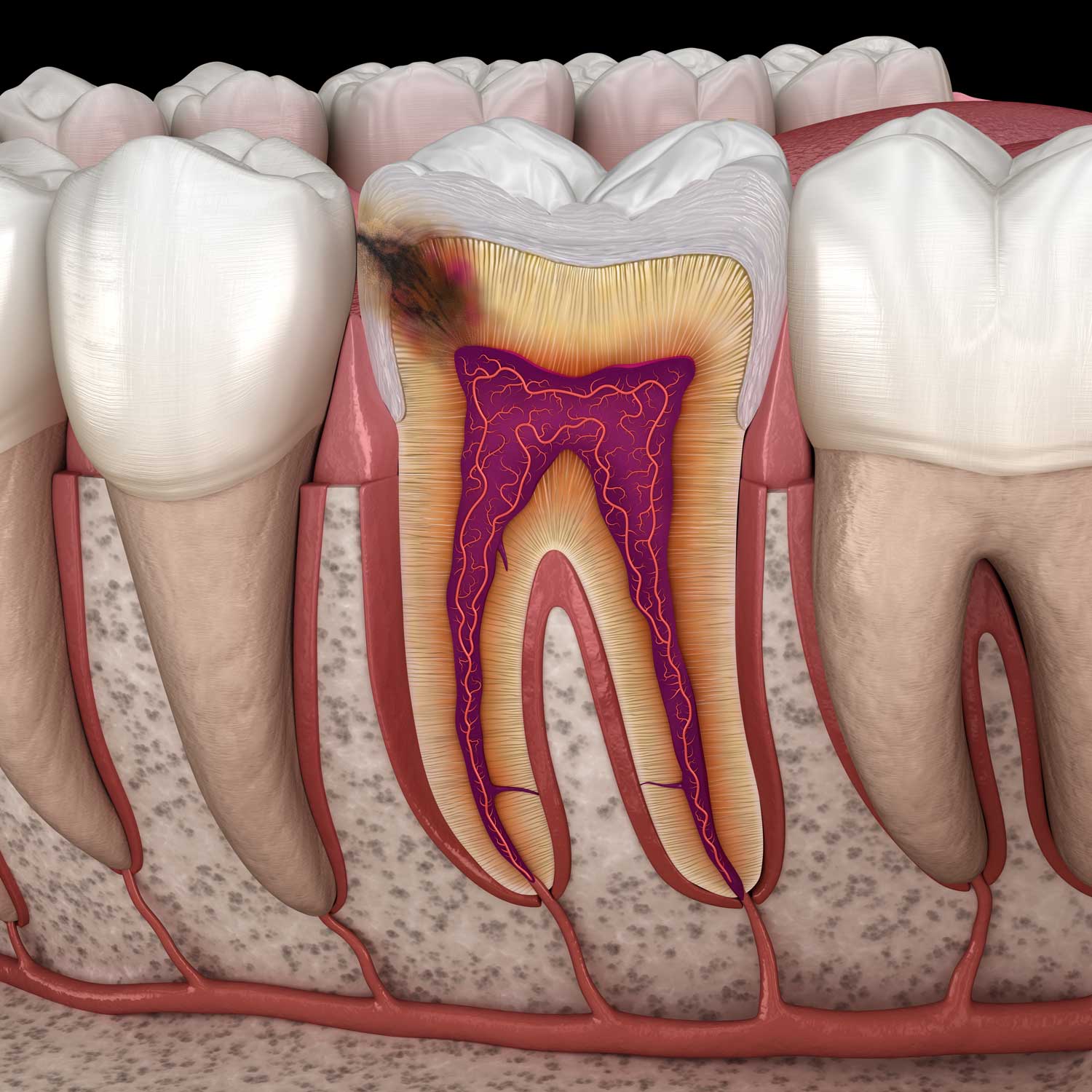 歯の内部イメージ